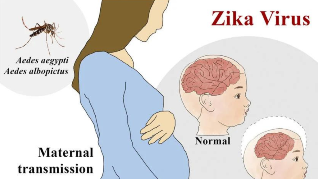 zika virus cases,zika virus pregnancy