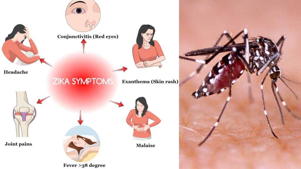 zika virus cases,Zika virus signs and symptoms